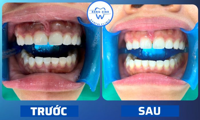 Hình ảnh trước và sau khi tẩy trắng răng.