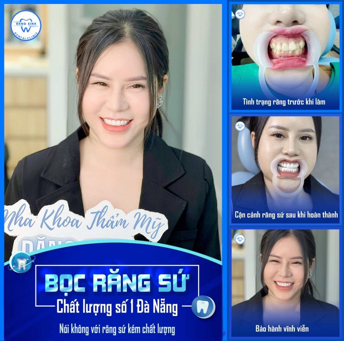 Nha khoa chuyên răng sứ dành cho Việt Kiều ở Đà Nẵng
